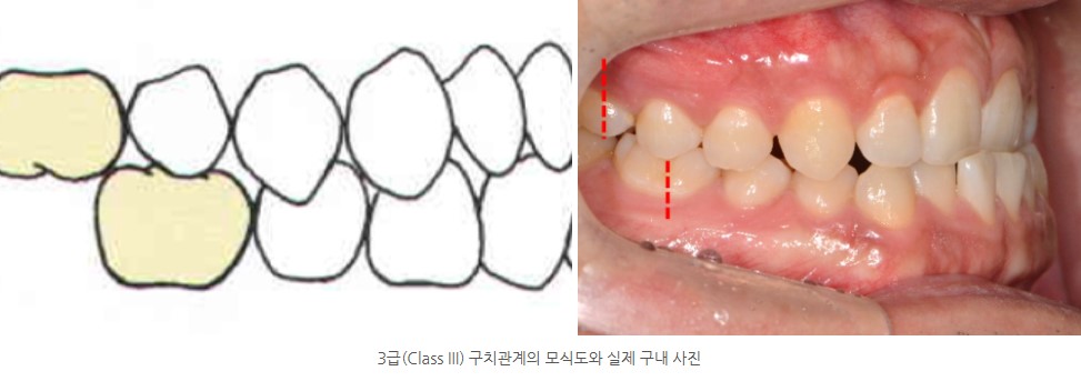 3급 구치관계의 모식도