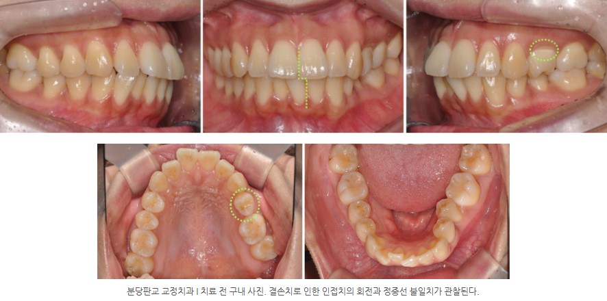 분당판교 교정치과 I 치료 전 구내 사진. 결손치로 인한 인접치의 회전과 정중선 불일치가 관찰된다.