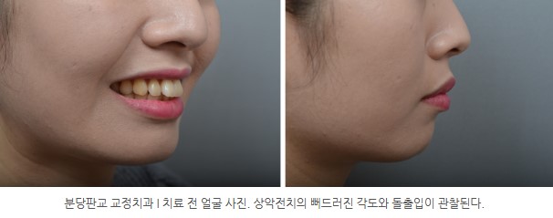 분당판교 교정치과 I 치료 전 얼굴 사진. 상악전치의 뻐드러진 각도와 돌출입이 관찰된다.