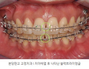 분당판교 교정치과 I 치아배열 후 나타난 블랙트라이앵글