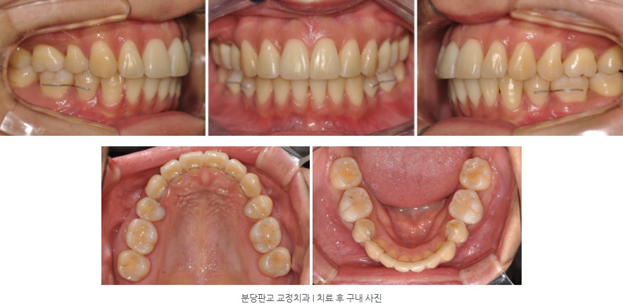 분당판교 교정치과 I 치료 후 구내 사진
