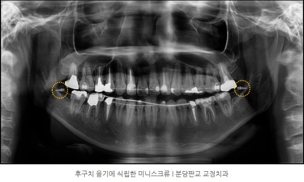주걱턱 교정 미니스크류 식립 I 분당판교 교정치과 서울리인치과 서울리인교정치과 주걱턱 교정 미니스크류 식립 I 분당판교 교정치과 서울리인치과 서울리인교정치과