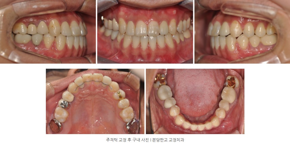 주걱턱 교정 후 구내 사진 I 분당판교 교정치과 서울리인치과 서울리인교정치과 주걱턱 교정 후 구내 사진 I 분당판교 교정치과 서울리인치과 서울리인교정치과