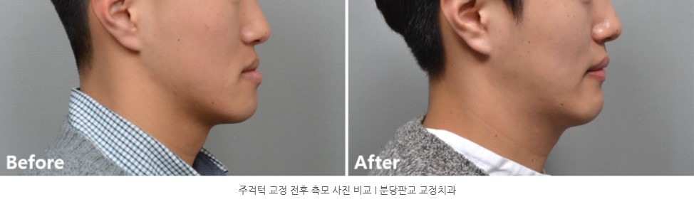 주걱턱 교정 전후 측모 사진 비교 I 분당판교 교정치과 서울리인치과 서울리인교정치과 주걱턱 교정 전후 측모 사진 비교 I 분당판교 교정치과 서울리인치과 서울리인교정치과