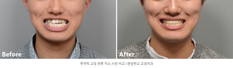 주걱턱 교정 전후 미소 사진 비교 I 분당판교 교정치과 서울리인치과 서울리인교정치과 주걱턱 교정 전후 미소 사진 비교 I 분당판교 교정치과 서울리인치과 서울리인교정치과