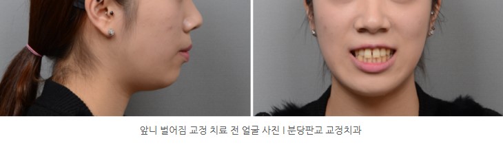 앞니 벌어짐 교정치료 전 I 판교교정치과 분당교정치과 앞니 벌어짐 교정치료 전 I 판교교정치과 분당교정치과