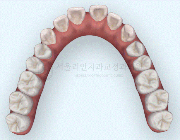 치아 사이 공간 폐쇄 I 판교교정치과 분당교정치과 치아 사이 공간 폐쇄 I 판교교정치과 분당교정치과