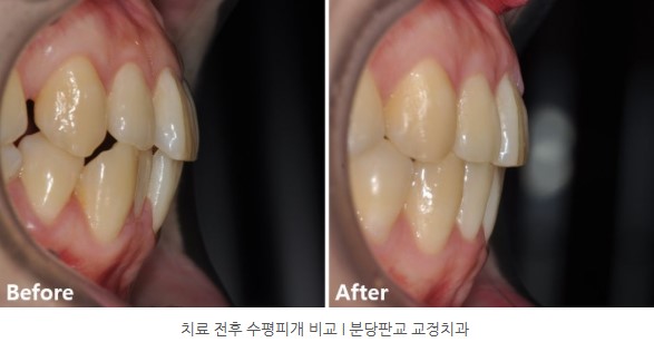교정치료 전후 비교 I 판교교정치과 분당교정치과 교정치료 전후 비교 I 판교교정치과 분당교정치과