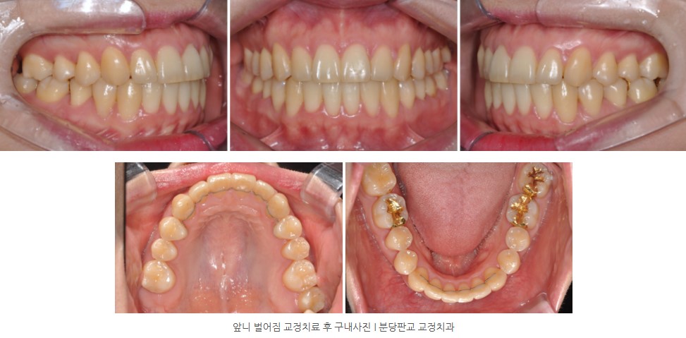 앞니벌어짐 교정치료 후 구내사진 I 판교교정치과 분당교정치과 앞니벌어짐 교정치료 후 구내사진 I 판교교정치과 분당교정치과