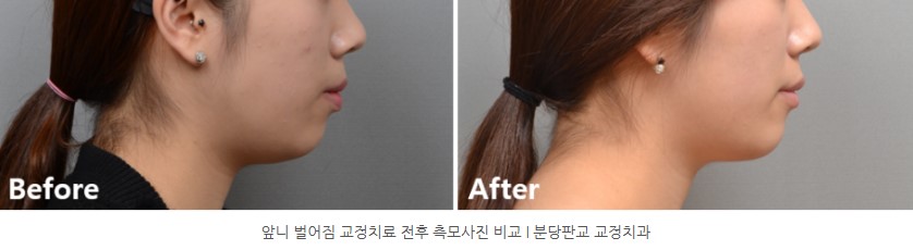 앞니 벌어짐 교정치료 후 측모 사진 I 판교교정치과 분당교정치과 앞니 벌어짐 교정치료 후 측모 사진 I 판교교정치과 분당교정치과