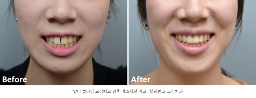 앞니 벌어짐 교정치료 후 미소사진 비교 I 판교교정치과 분당교정치과 앞니 벌어짐 교정치료 후 미소사진 비교 I 판교교정치과 분당교정치과