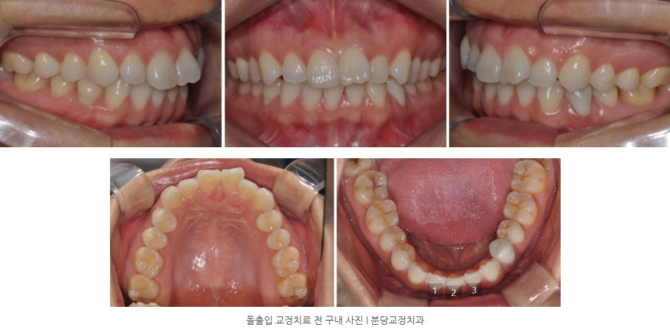 돌출입 교정치료 전 구내 사진 I 분당교정치과