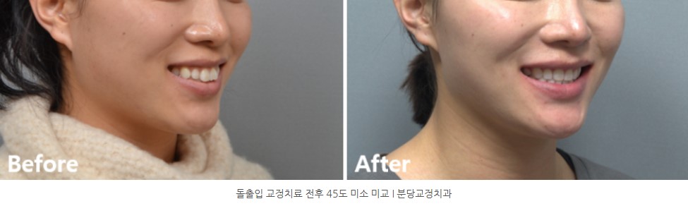 돌출입 교정치료 전후 45도 미소 사진 I 분당교정치과