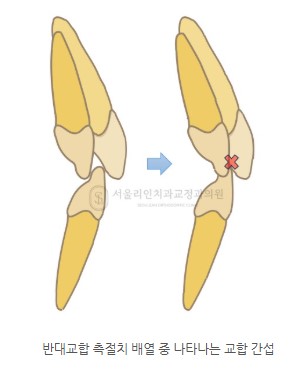 측절치 반대교합 I 분당교정치과 판교교정치과 서울리인치과