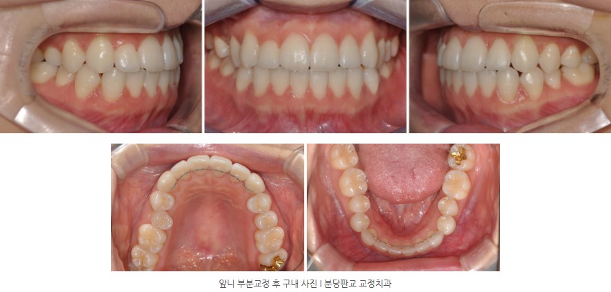 앞니교정 후 구내사진 I 분당교정치과 판교교정치과 서울리인치과
