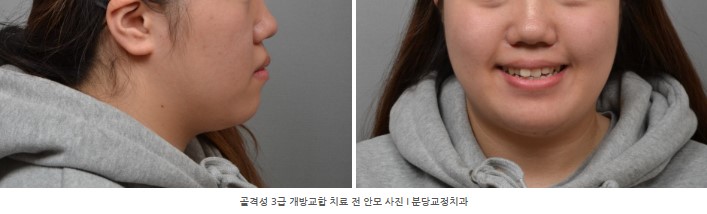 돌출을 동반한 골격성 3급 개방교합 치료 전 안모 사진 I 분당교정치과 서울리인치과