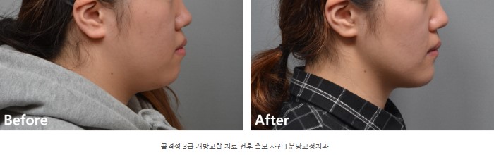 돌출을 동반한 골격성 3급 개방교합 치료 전후 측모 사진 I 분당교정치과 서울리인치과