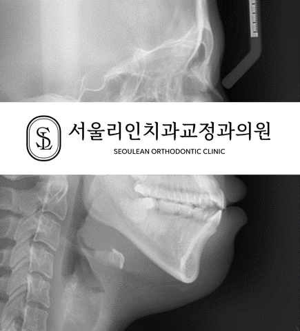 돌출을 동반한 골격성 3급 개방교합 치료 전후 엑스레이 비교 I 분당교정치과 서울리인치과