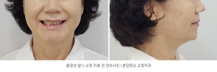 중장년 앞니 교정치료 전 얼굴사진 I 분당판교교정치과