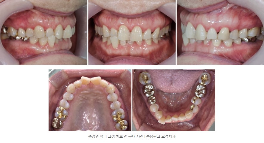 중장년 앞니 교정치료 전 구내 사진 I 분당판교교정치과