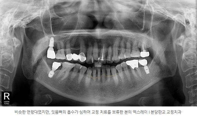 치조골 소실로 교정 치료 보류한 환자의 치아 엑스레이 I 분당판교교정치과