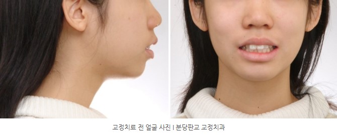 사춘기 치아교정 전 얼굴 사진 분당교정치과 판교교정치과 서울리인치과 사춘기 치아교정 전 얼굴 사진 분당교정치과 판교교정치과 서울리인치과