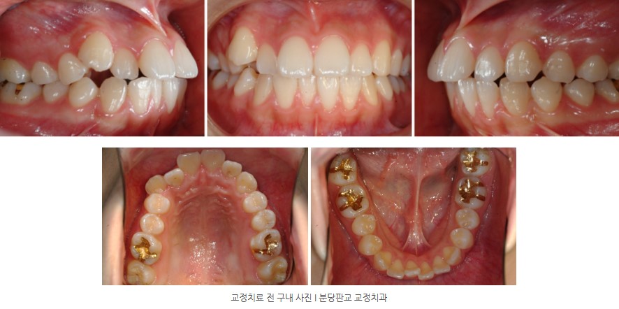 사춘기 치아교정 전 구내 사진 분당교정치과 판교교정치과 서울리인치과 사춘기 치아교정 전 구내 사진 분당교정치과 판교교정치과 서울리인치과
