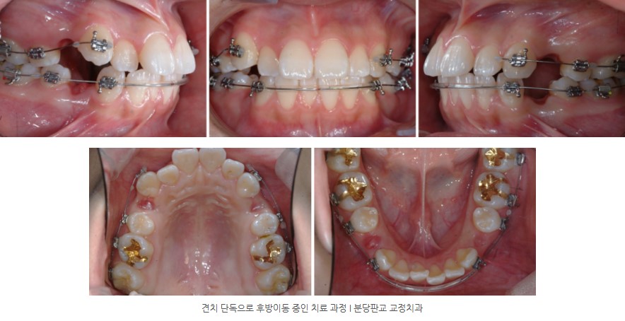 사춘기 치아교정 중 구내사진 분당교정치과 판교교정치과 서울리인치과 사춘기 치아교정 중 구내사진 분당교정치과 판교교정치과 서울리인치과