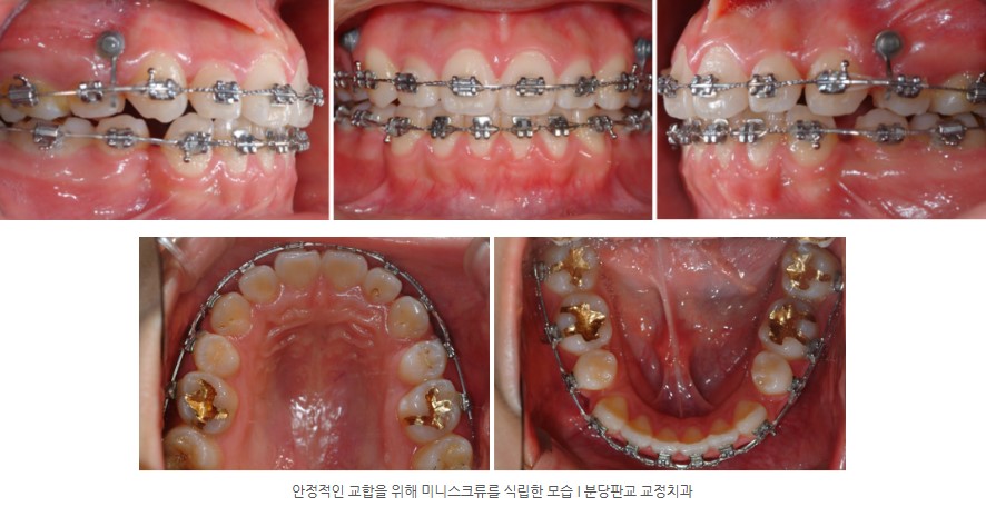 청소년기 치아교정 미니스크류 분당교정치과 판교교정치과 서울리인치과