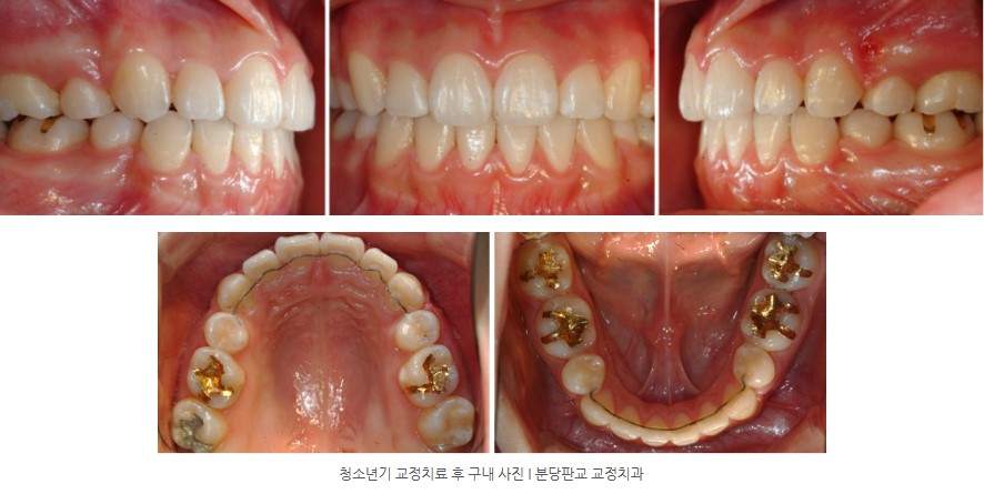 청소년기 치아교정 후 구내사진 분당교정치과 판교교정치과 서울리인치과 청소년기 치아교정 후 구내사진 분당교정치과 판교교정치과 서울리인치과