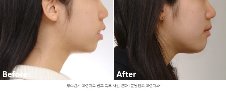 청소년기 치아교정 전후 측모 변화 분당교정치과 판교교정치과 서울리인치과 청소년기 치아교정 전후 측모 변화 분당교정치과 판교교정치과 서울리인치과