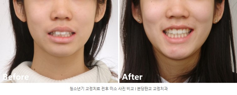 사춘기 치아교정 전후 미소변화 분당교정치과 판교교정치과 서울리인치과 사춘기 치아교정 전후 미소변화 분당교정치과 판교교정치과 서울리인치과