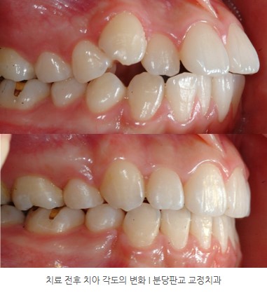 청소년 치아교정 전후 치아각도 변화 분당교정치과 판교교정치과 서울리인치과 청소년 치아교정 전후 치아각도 변화 분당교정치과 판교교정치과 서울리인치과