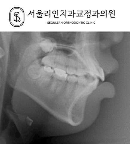 청소년 치아교정 전후 엑스레이 변화 분당교정치과 판교교정치과 서울리인치과 청소년 치아교정 전후 엑스레이 변화 분당교정치과 판교교정치과 서울리인치과
