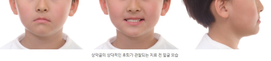 성장기 주걱턱 교정 서울리인치과교정과의원