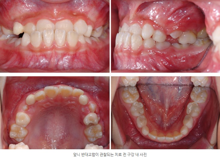 분당판교 성장기 주걱턱 교정치료 전 서울리인치과교정과