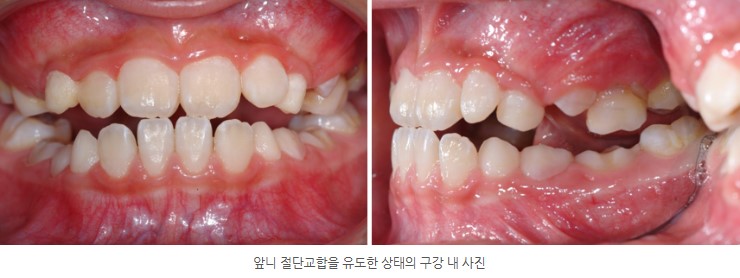 분당판교 성장기 주걱턱 교정치료 전 서울리인치과교정과