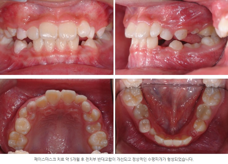 분당판교 성장기 주걱턱 교정치료 과정 서울리인치과교정과