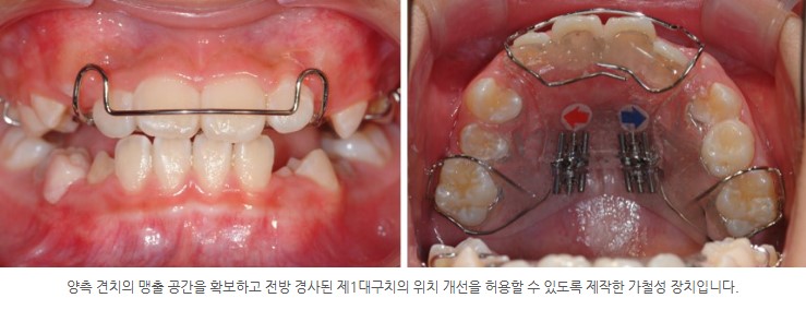 분당판교 성장기 영구치 공간 부족치료 서울리인치과교정과