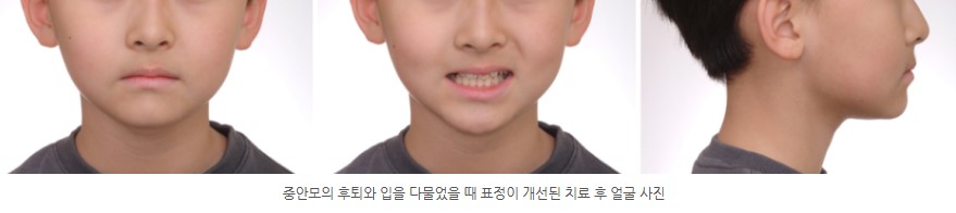 분당판교 성장기 주걱턱 교정치료 후 서울리인치과교정과