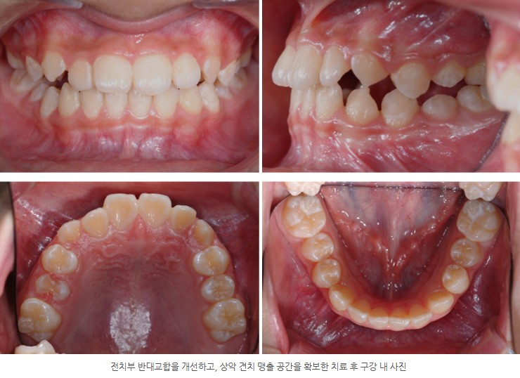 분당판교 성장기 주걱턱 교정치료 후 서울리인치과교정과