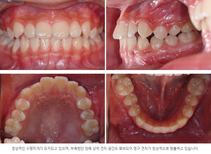 분당판교 성장기 주걱턱 교정치료 6개월 경과관찰 서울리인치과교정과