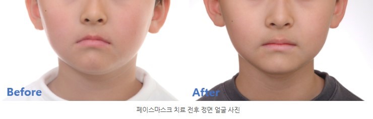 분당판교 성장기 주걱턱 교정치료 전후 정면 서울리인치과교정과
