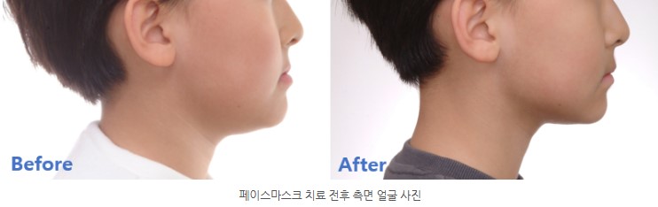 분당판교 성장기 주걱턱 교정치료 전후 측모 서울리인치과교정과